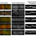 Scientists discover gene responsible for rare, inherited eye disease