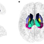 Genetic variants linked to ADHD and Parkinson’s, Queensland led study on brain size finds