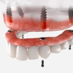 Why Choose an Implant-Secured Denture